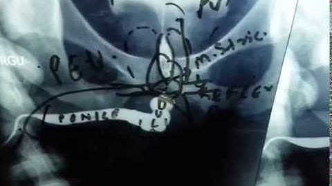 Retrograde Urethrogram [RGU/MCU] Interpretation Basics