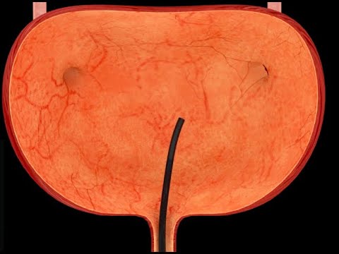 تنظير المسالك البولية كيف يتم الإجراء وما الفائدة منه