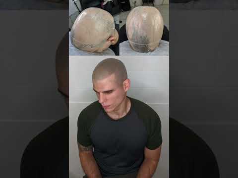 Scalp Micropigmentation For