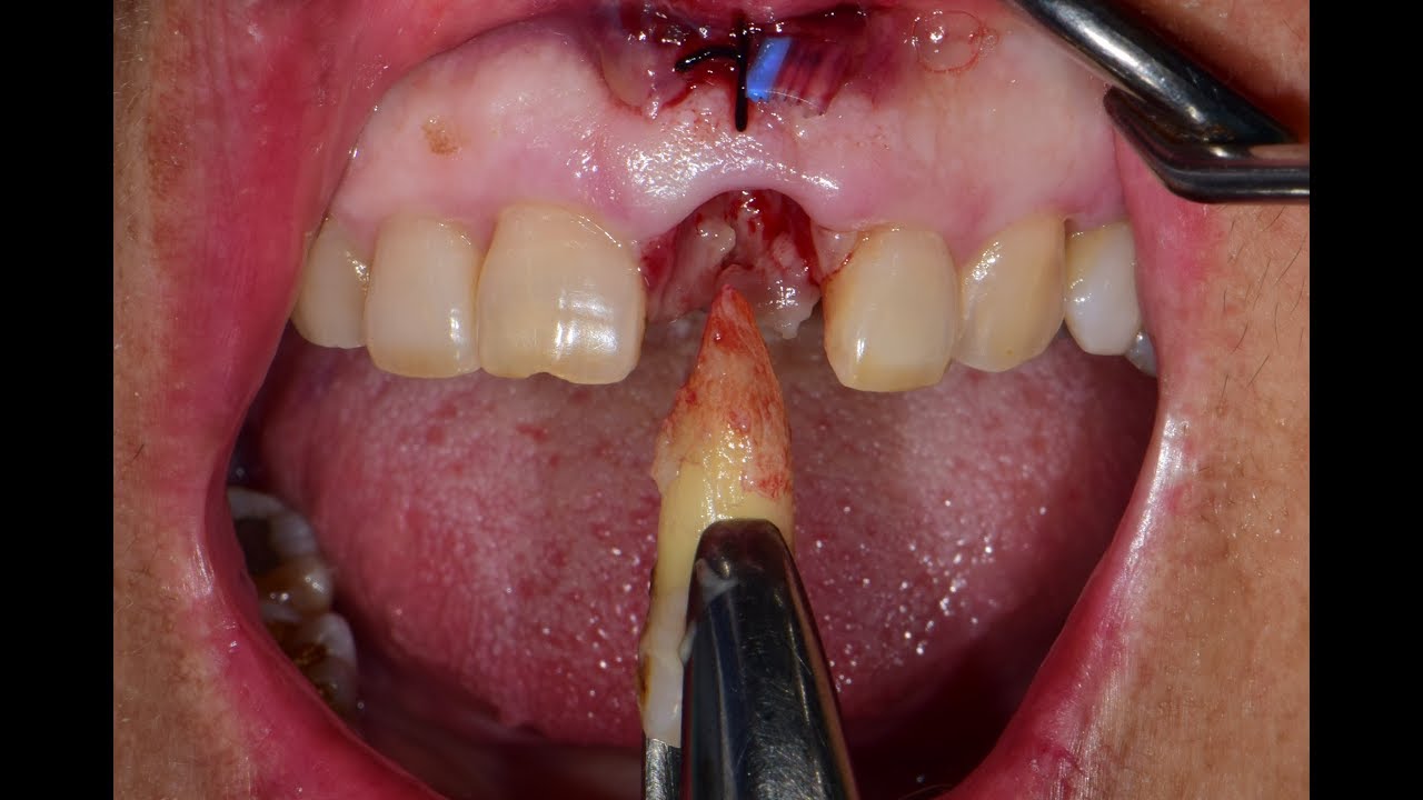 Ridge preservation and delayed implant placement in esthestic area