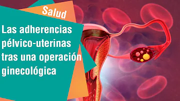 Qual o tratamento para aderência pélvica?