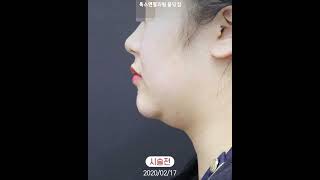 턱끝필러로 내 턱이 브이라인이 되었네요~!