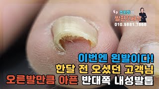 이번엔 왼쪽이다(2월3일 2탄)  #발 #발톱 #내성발톱 #무좀발톱 #대구내성발톱