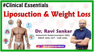 Liposuction and Weight Loss  Dr.Ravi Sankar Endocrinologist MRCP(UK) CCT  GIM (UK)