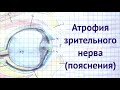 Атрофия зрительного нерва, пояснения