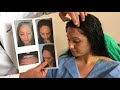Immediately After a Hairline Lowering/Forehead Shortening Surgery