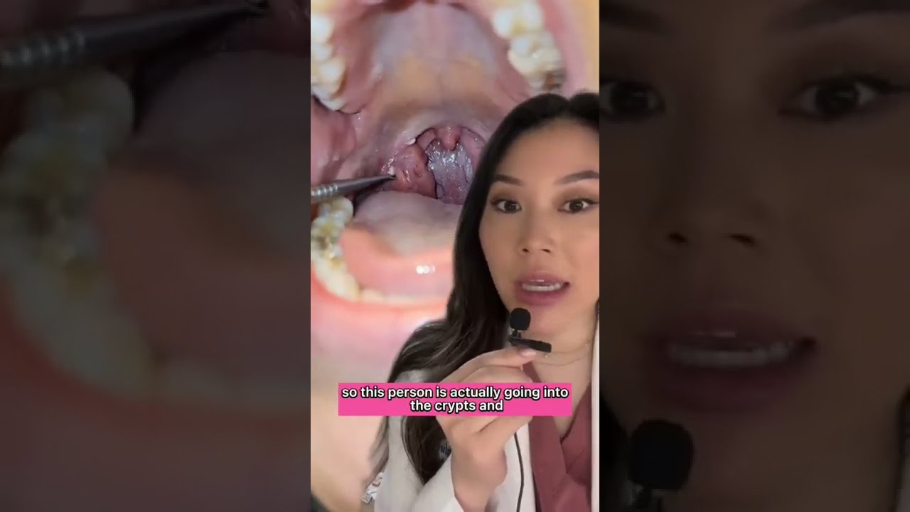 WhOA Mining For Tonsil Stones With A Blackhead Removal Tool Tonsilstones