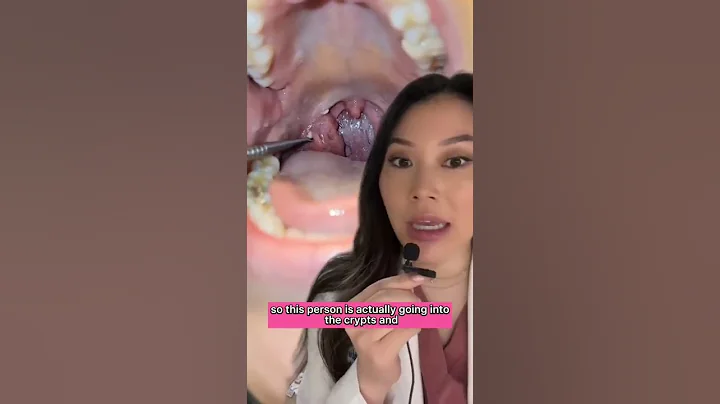 WhOA Mining for Tonsil Stones with a Blackhead removal tool #tonsilstones