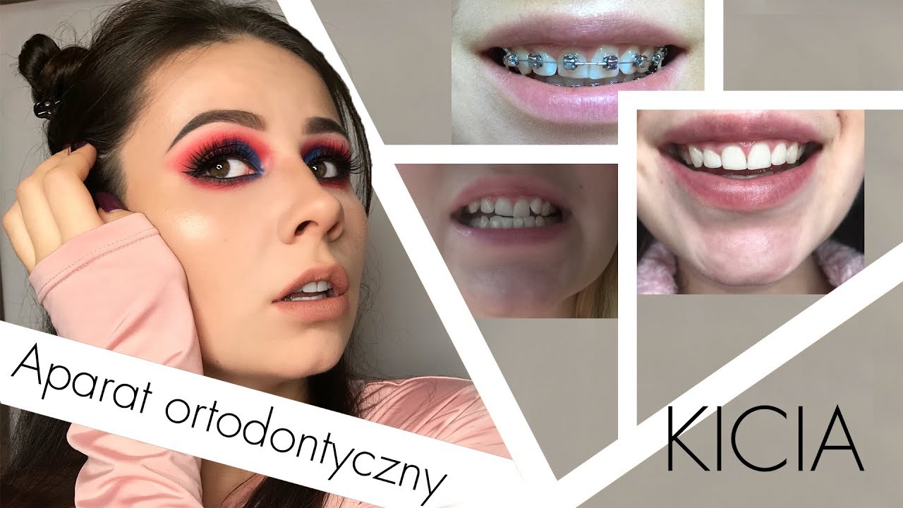 Aparat ortodontyczny DAMON Q moja historia ^---^