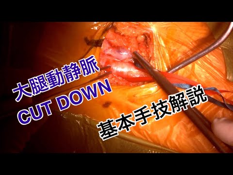 【心臓外科基本手技】 大腿動静脈 cut downの基本を教えます 【手術しようぜ！】