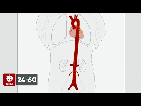 Vidéo: La coarctation de l'aorte est-elle cyanotique ?
