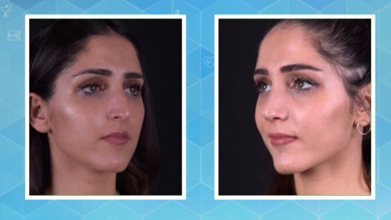 علاج تشوهات الأنف!