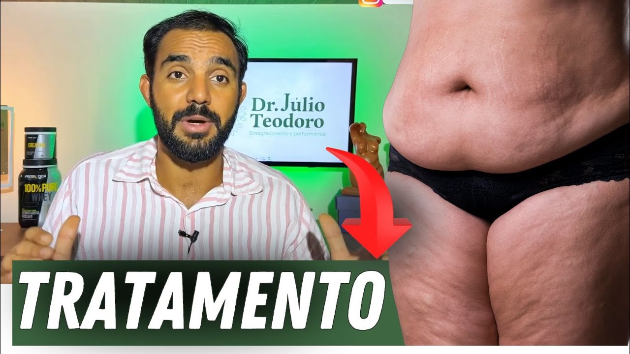 Celulite e Lipedema nas Pernas: Massagem Modeladora Resolve Mesmo? Descubra o Melhor Tratamento