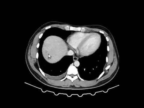 Abscesso hepático