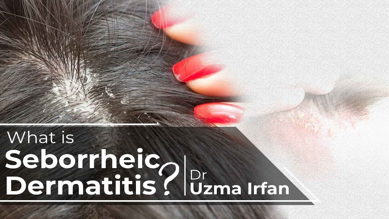 Seborrheic Dermatitis | DR UZMA IRFAN