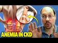 Anemia in Chronic Kidney Disease Video #2 Anemia and Kidney Disease Treatment Vitamins, Drugs &amp; More