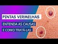 Pintas vermelhas - Entenda as causas e como tratá-las