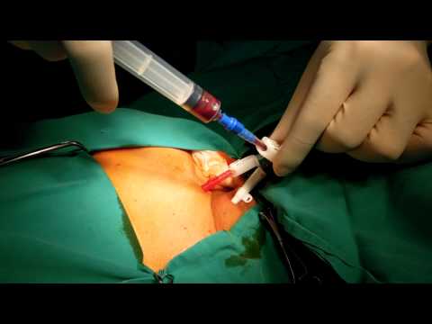 Double Lumen CatheterizationABLE Cath