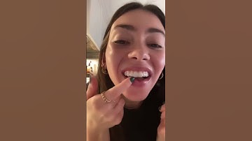 She Didn’t Wear Her Retainers For MONTHS… She Put Them In And THIS Happened | TheBentist