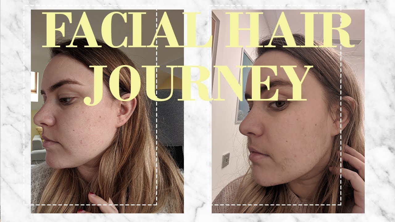 My Facial Hair Journey (PCOS) TOPAZ&MAY YouTube