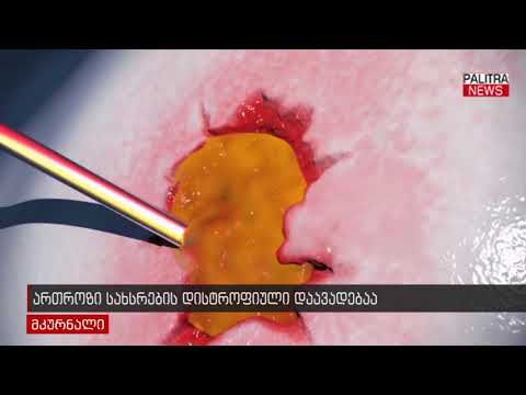 ართროზი სახსრების დისტროფიული დაავადება