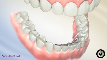 Curve of Spee Correction, Lower Cantilever | Dental Braces | Temecula Valley, CA