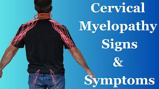 Cervical Myelopathy Signs and Symptoms (Revisited)