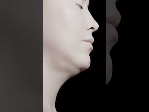 Neck lift, deep