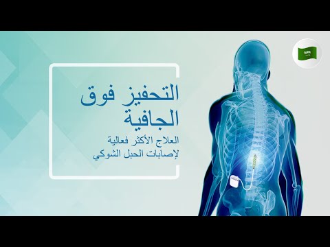 التحفيز فوق الجافية: العلاج الأكثر فعالية لإصابات الحبل الشوكي