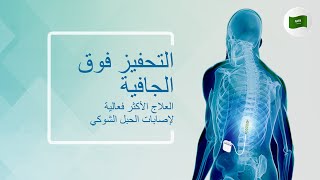 التحفيز فوق الجافية: العلاج الأكثر فعالية لإصابات الحبل الشوكي