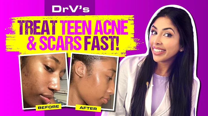 FASTEST WAY to RID Acne in teens- Dr V.