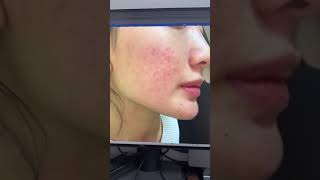 Chúc các bệnh nhân luôn hết bệnh nhé mụn mủ viêm da nặng#drtrangiakhanh #zahanclinic #capcut #trịmụn