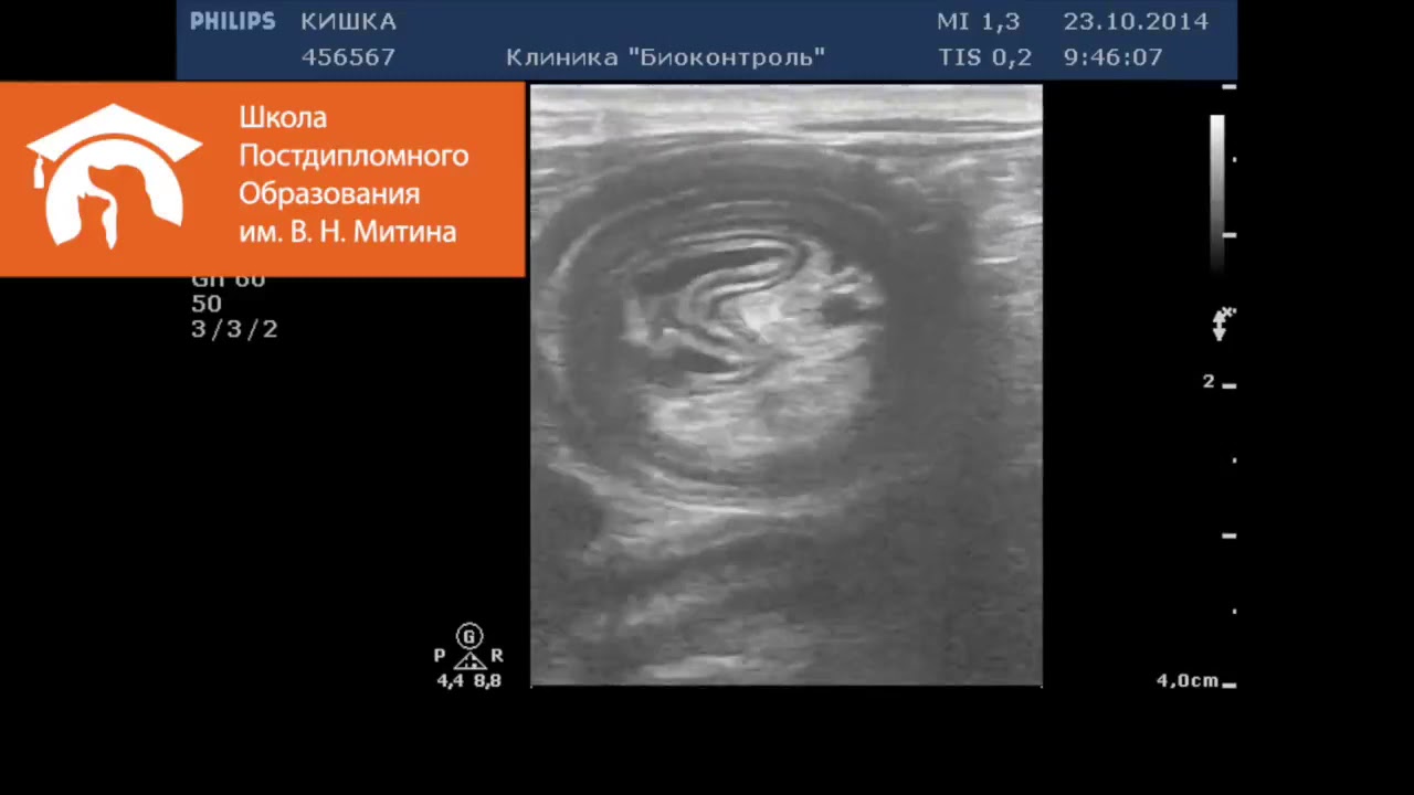 Инвагинация /2 - YouTube