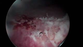 Удаление лейкоплакии мочевого пузыря при помощи гольмий-неодимового лазера.