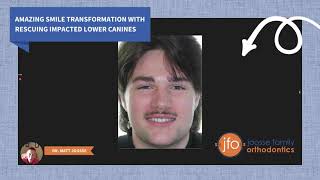 Amazing Smile by Rescuing Impacted Lower Canines | Joosse Family Orthodontics | Williamsburg, VA