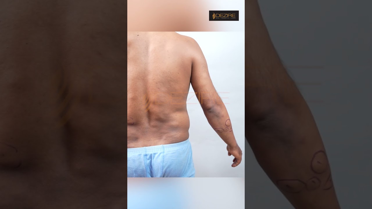 Multiple Lipoma Marking before surgery