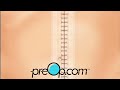  aaa surgery explained  preop healthawareness  preop patient education