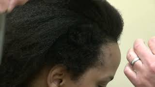 African American Woman Hair Transplant | 1-Year Results Before & After