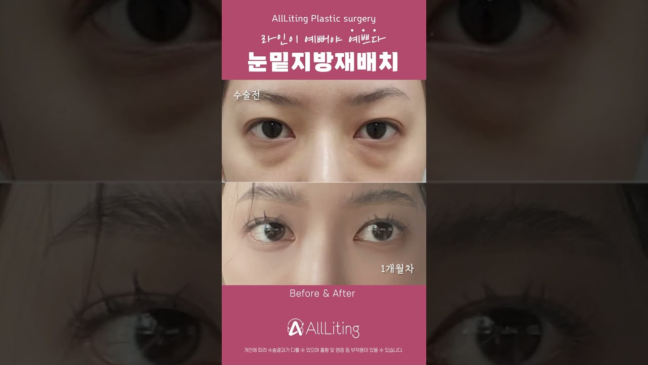 [奧莉婷整形外科診所] 不知為何看起來很疲憊的我的眼睛 😭 那時候 #眼下脂肪重置 👀是答案嗎？！ #眼下脂肪重置 #外眼角固定 #眼瞼 #眼下脂肪 #眼下脂肪去除 #江南 #上揚整形 #江南整形外科