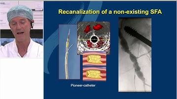 Alternative Access and Crossing Techniques for Challenging Femoral Popliteal CTOs