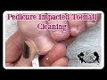 👣Pedicure How to Clean Impacted Toenails  👣⭐