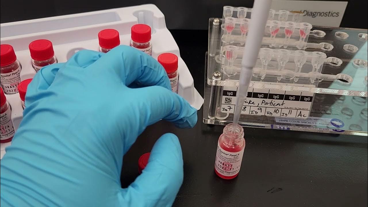 blood-banking-how-to-perform-a-gel-antibody-identification-panel-youtube