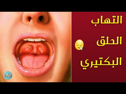 فيديو: كيفية منع بكتيريا الحلق (بالصور)