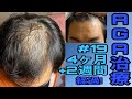 AGA治療4ヶ月+2週間経過！先週に引き続き…ですがいつの日か参考に！