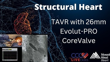 TAVR with 26mm Evolut-PRO CoreValve - May 8, 2018