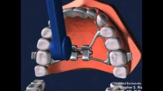 Seattle Orthodontist Dr. Christopher Riolo: Banded Expander, RPE