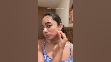 Tried Electronic patches on my pimples and made it worse? 🥺🤯