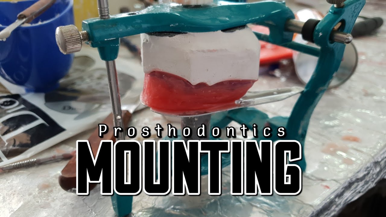 Prosthodontics | MOUNTING