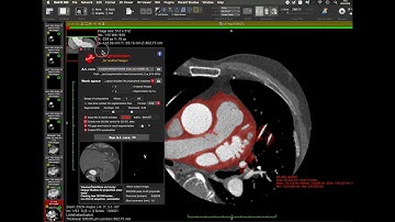 Heart segmentation to 3D STL data in OsiriX by A.I.Segmentation