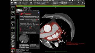 Heart segmentation to 3D STL data in OsiriX by A.I.Segmentation